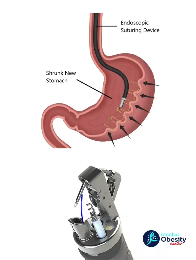 Endoscopic sleeve gastroplasty diagram showing stomach suturing and endoscopic device