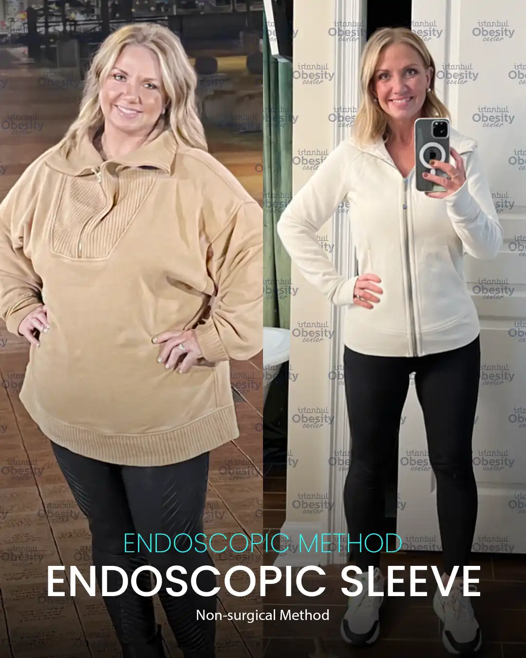 Before and after endoscopic sleeve in Turkey – female patient body transformation