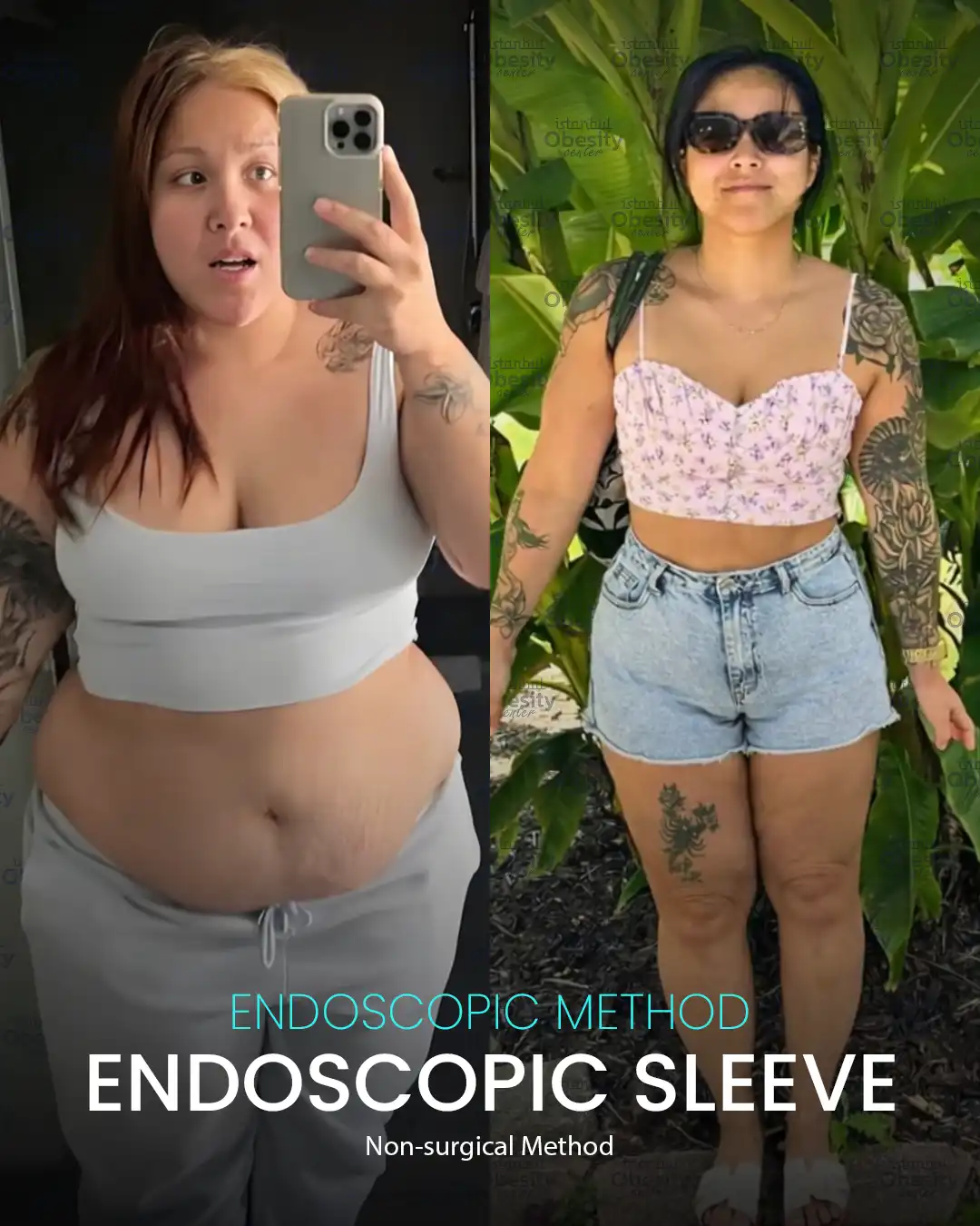 Before and after endoscopic sleeve gastroplasty in Turkey – female patient weight loss results