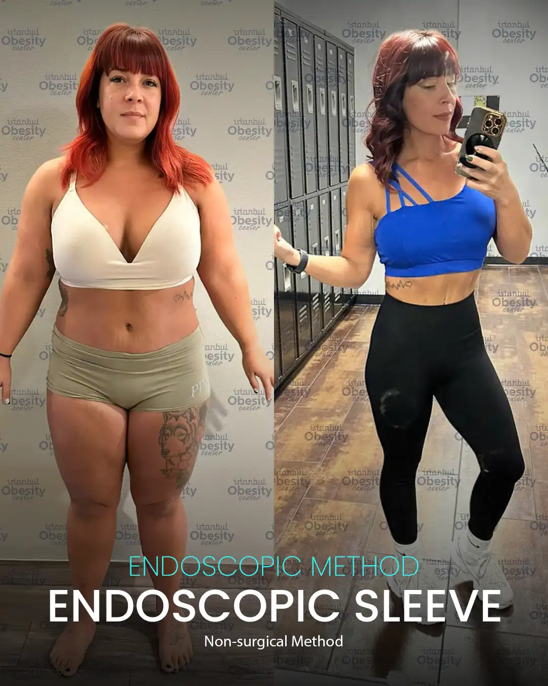 Before and after endoscopic sleeve in Turkey – female patient weight loss transformation