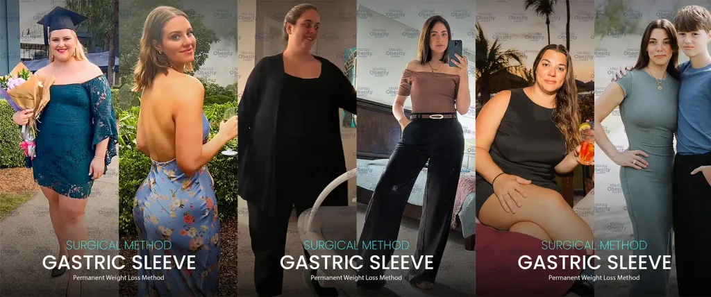 gastric sleeve before after 1