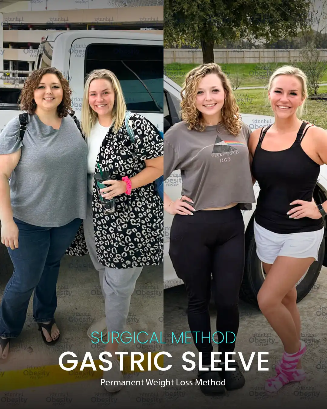 gastric sleeve before after Turkey real patient