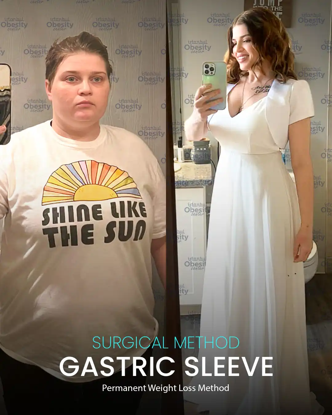 weight loss surgery before after Turkey female