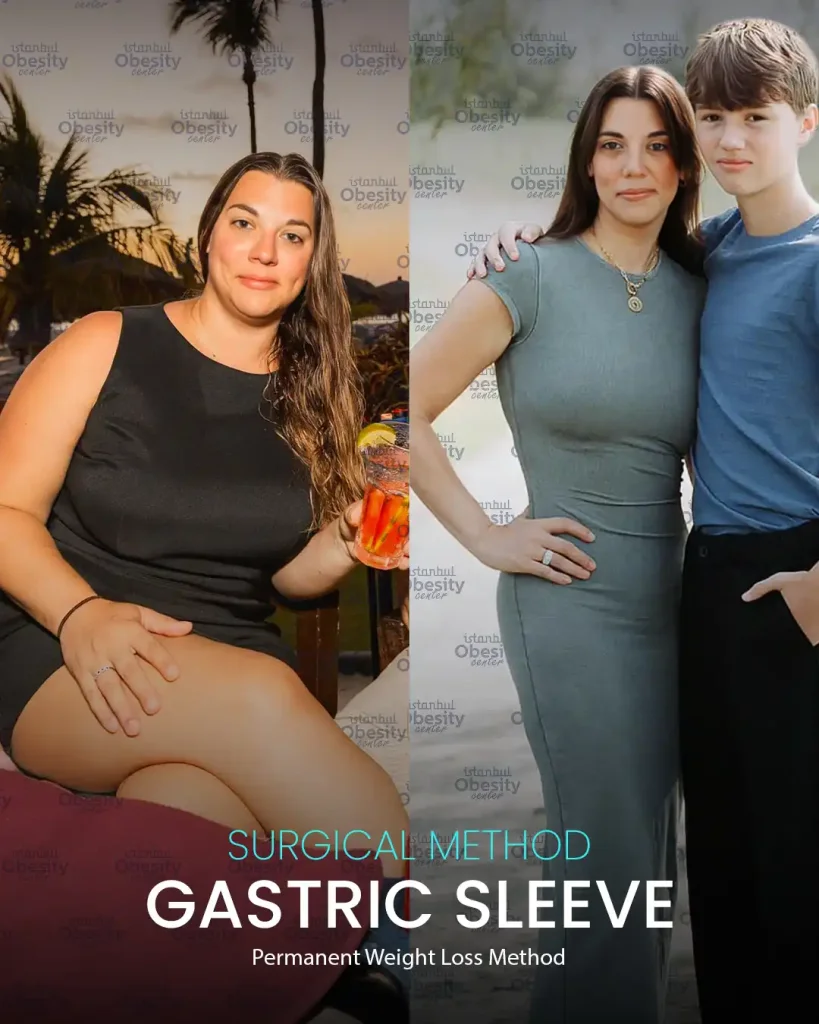gastric sleeve transformation Turkey weight loss