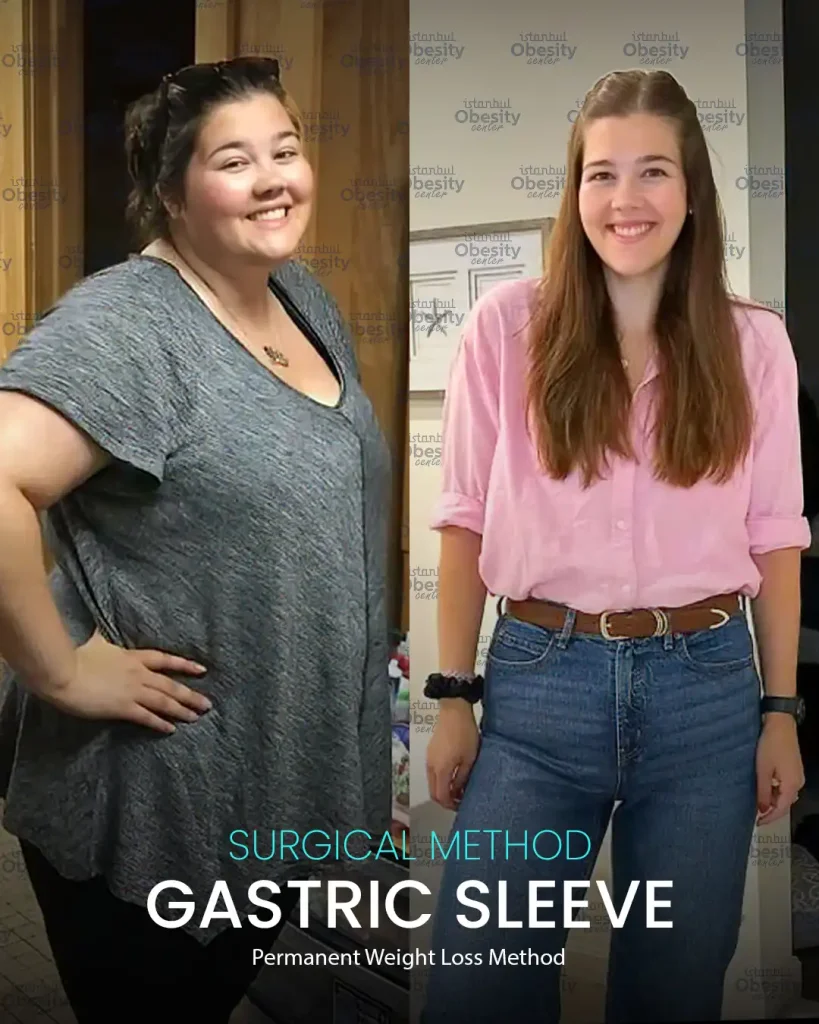 bariatric surgery before after Turkey female patient