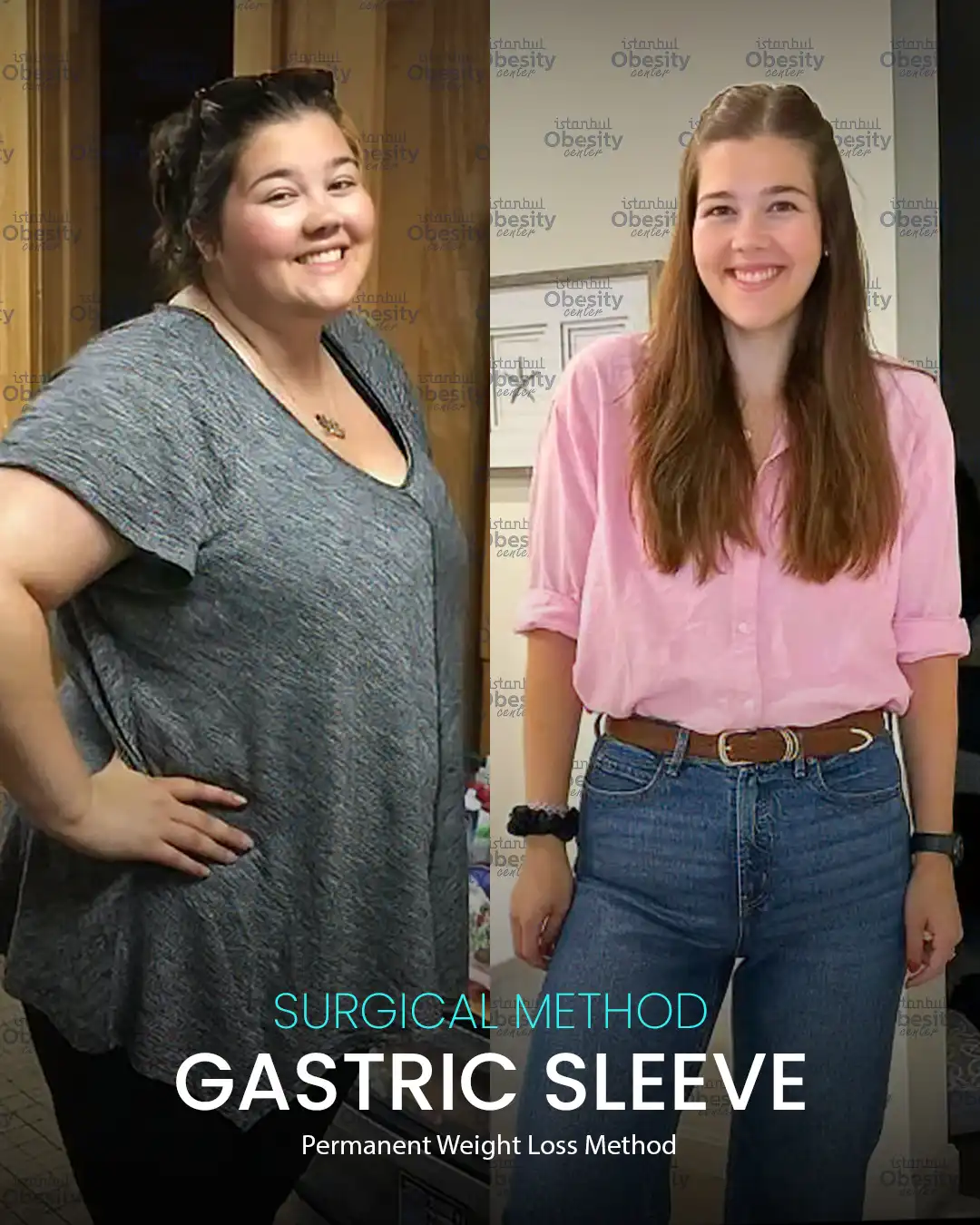 bariatric surgery before after Turkey female patient
