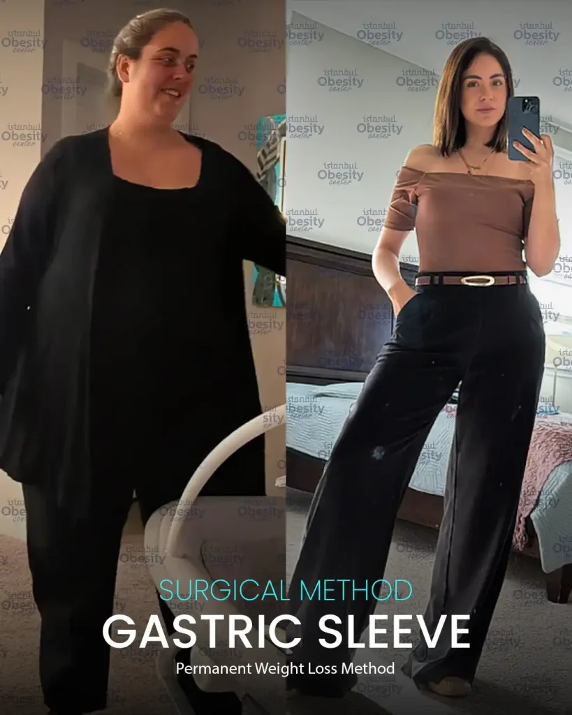 gastric sleeve results Turkey before and after female