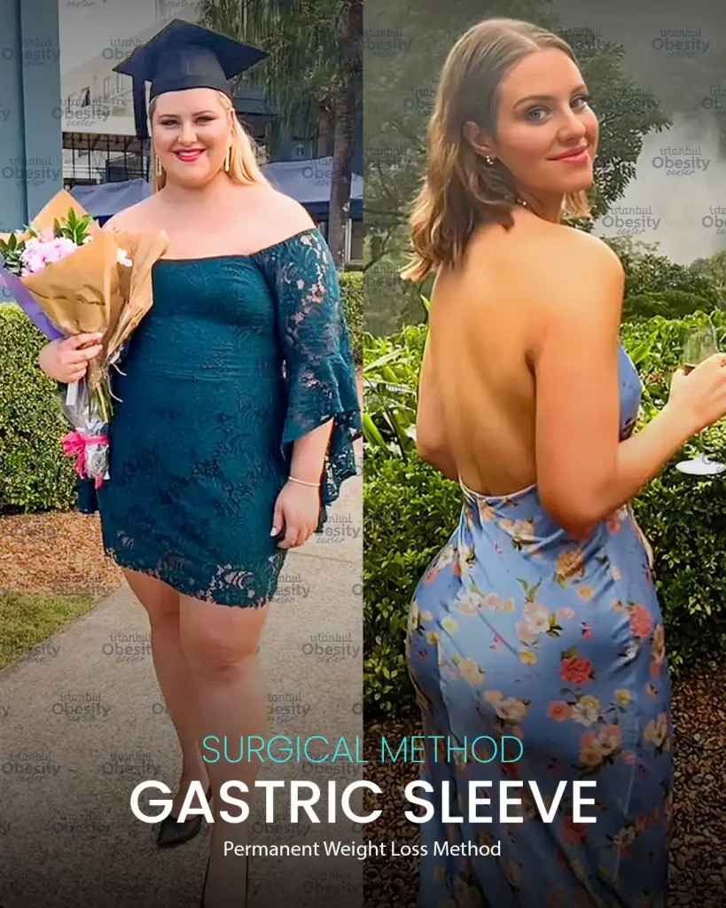 gastric sleeve before after Turkey 6 month female patient transformation