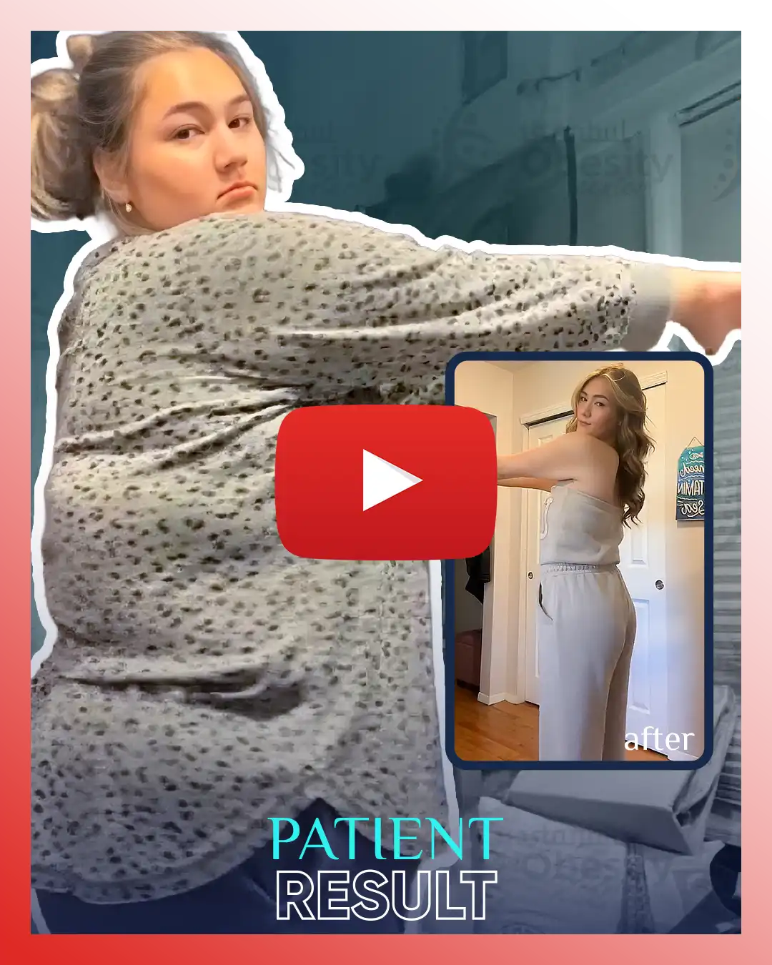 1 gastric sleeve patient uk before after