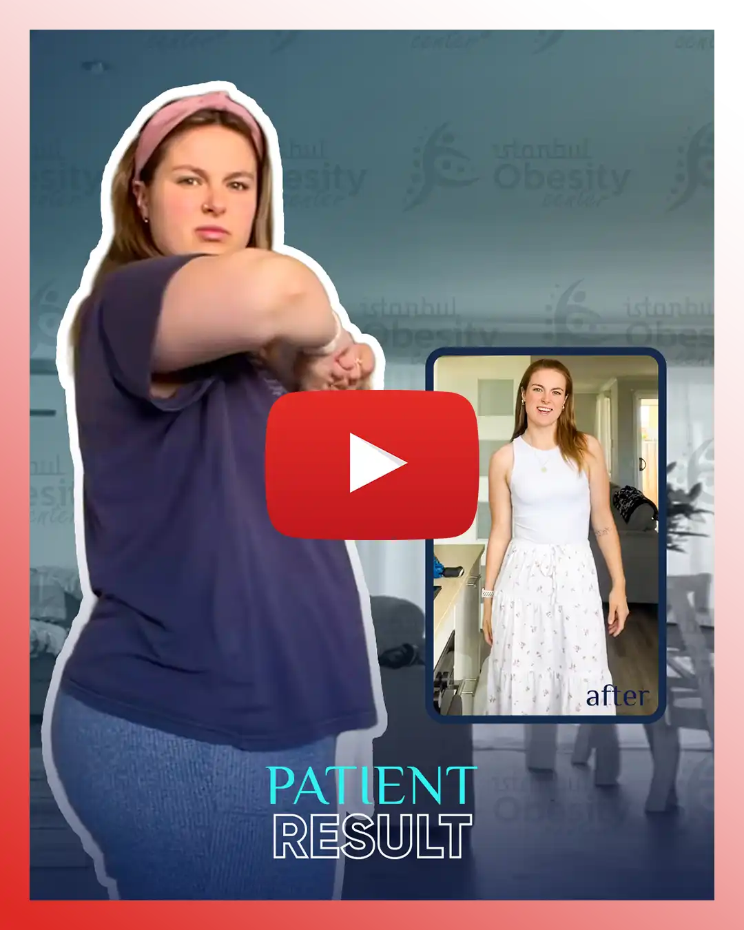 3 gastric sleeve patient uk before after