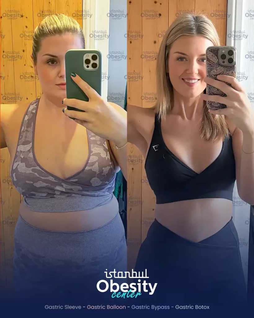 gastric sleeve before after turkey patient weight loss result