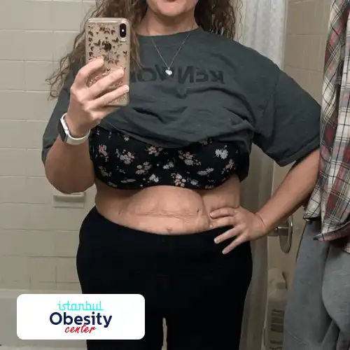 1 gastric sleeve scars