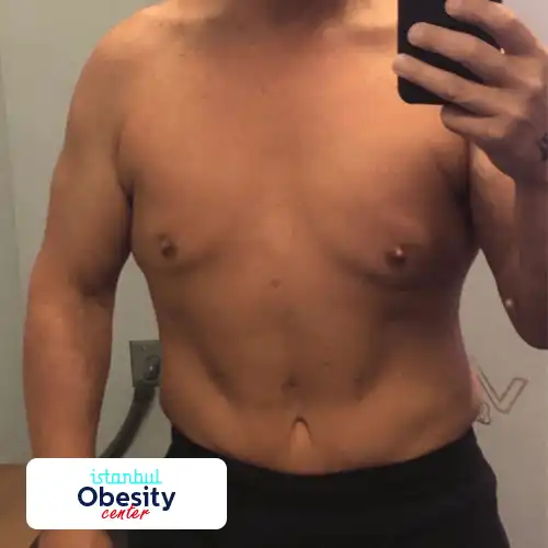 2 gastric sleeve scars