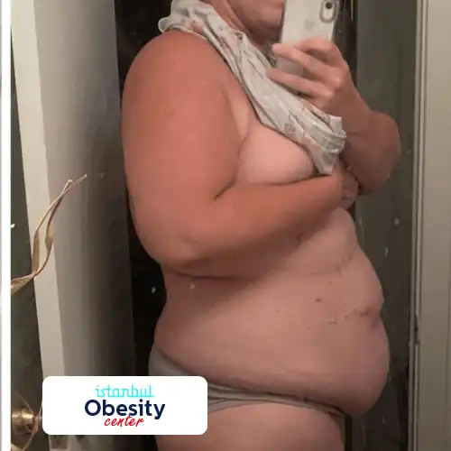 4 gastric sleeve scars