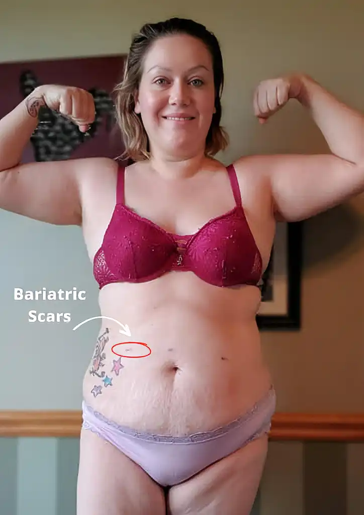 gastric sleeve scar 9