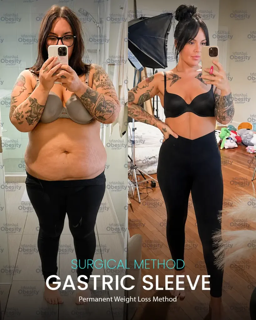 Real patient transformation after gastric sleeve surgery at Istanbul Obesity Center. Results may vary from person to person.
