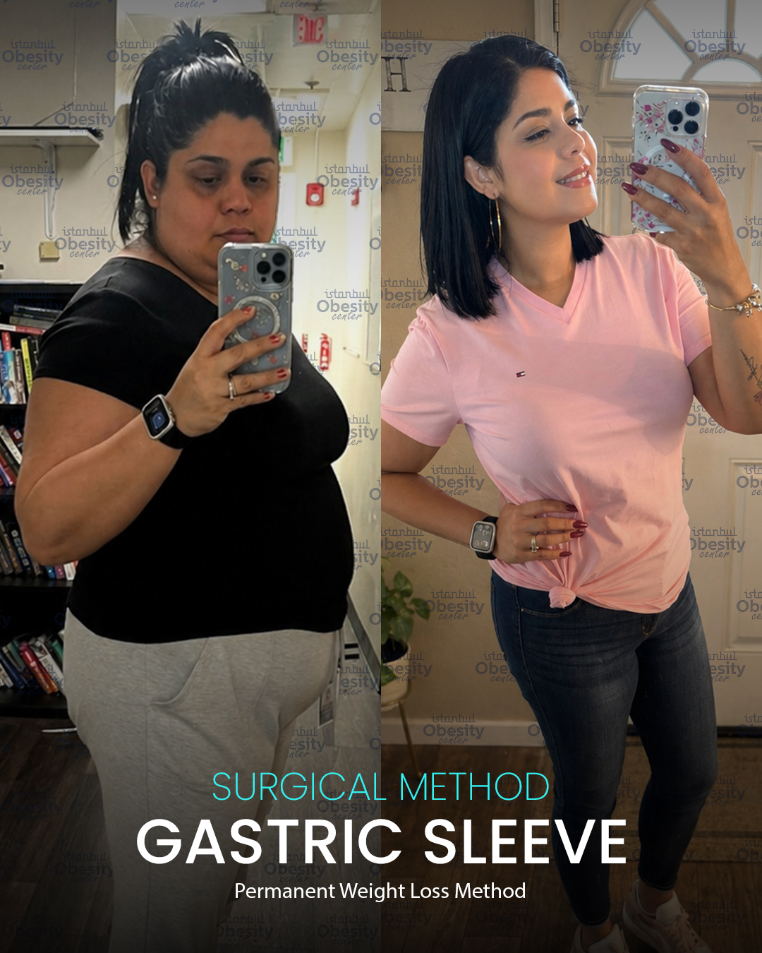 gastirc sleeve in turkey 16