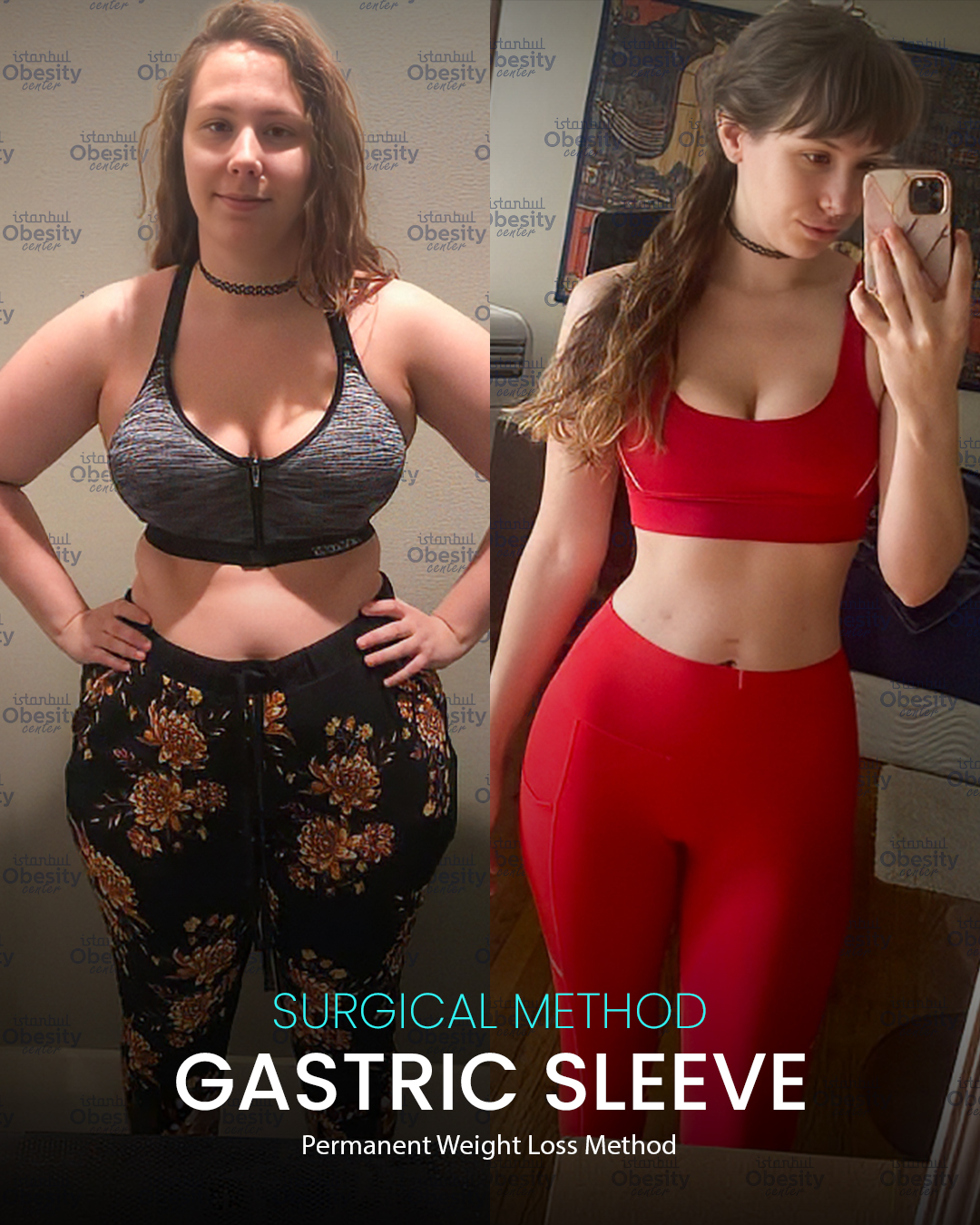 gastirc sleeve in turkey 17
