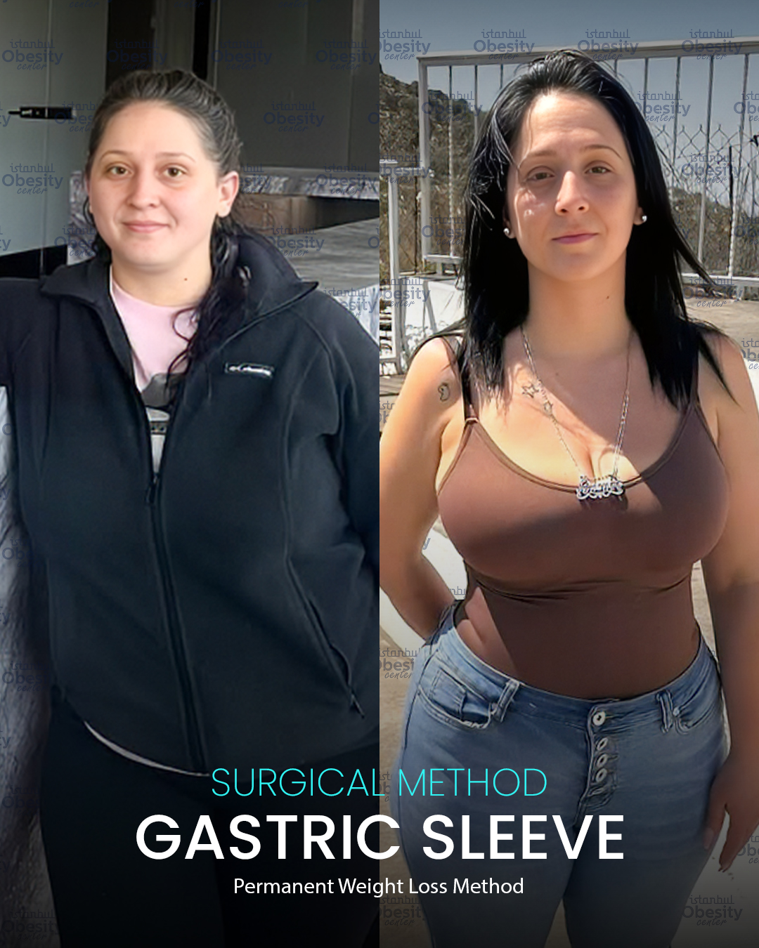 gastirc sleeve in turkey 18
