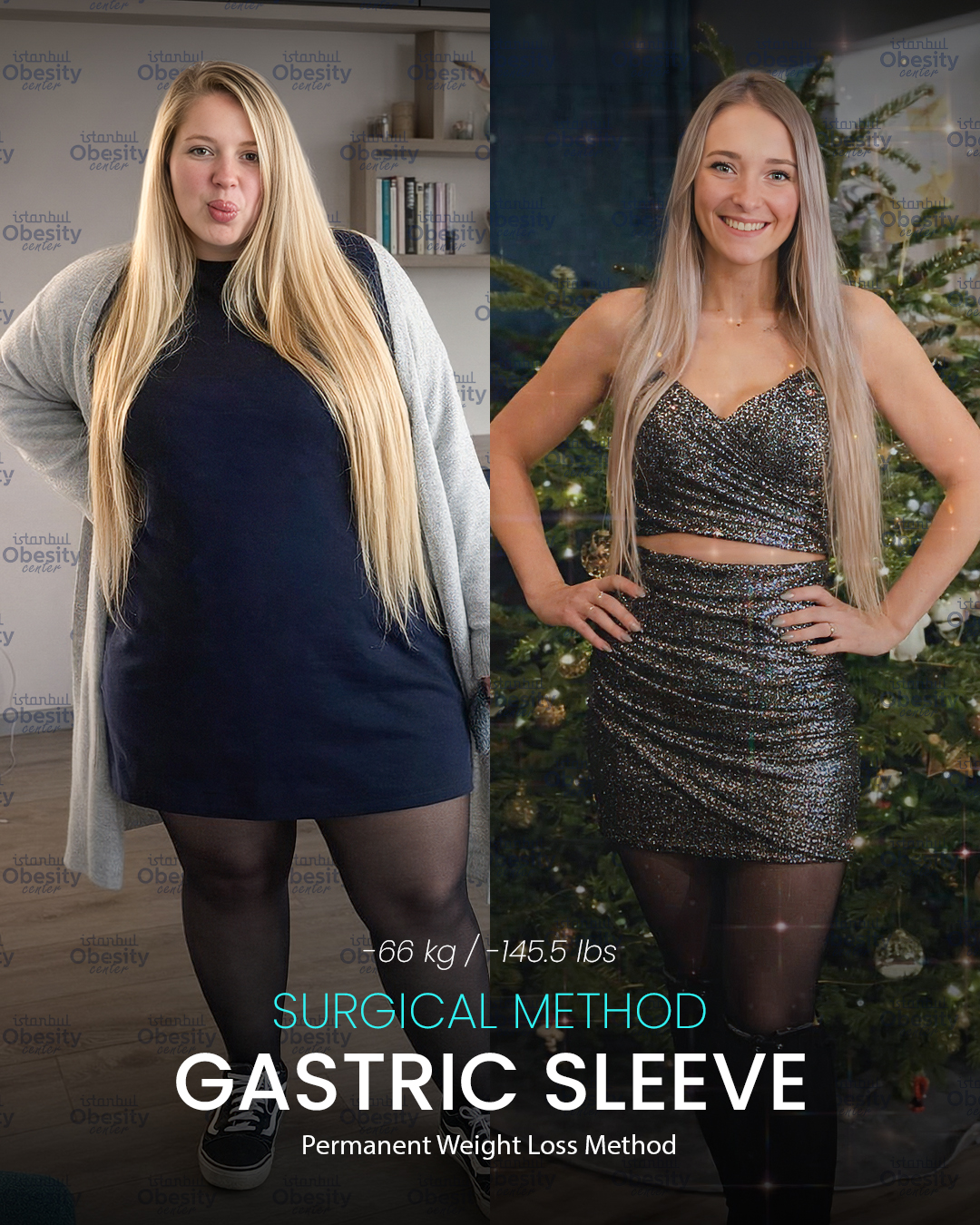 gastirc sleeve in turkey 19