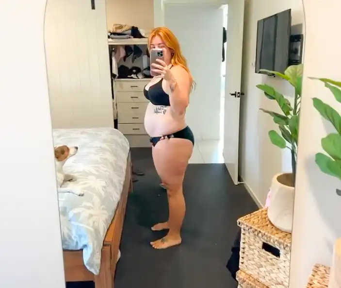 Gastric sleeve before photo patient at 105kg