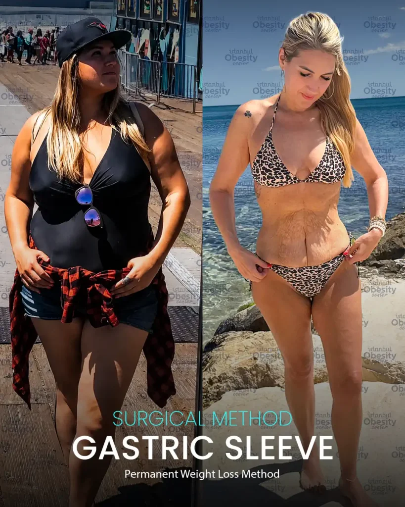 samantha 120lbs gastric sleeve